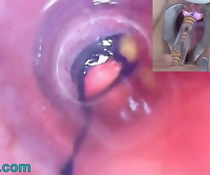 Mature Woman Peehole Endoscope Camera in Bladder with..